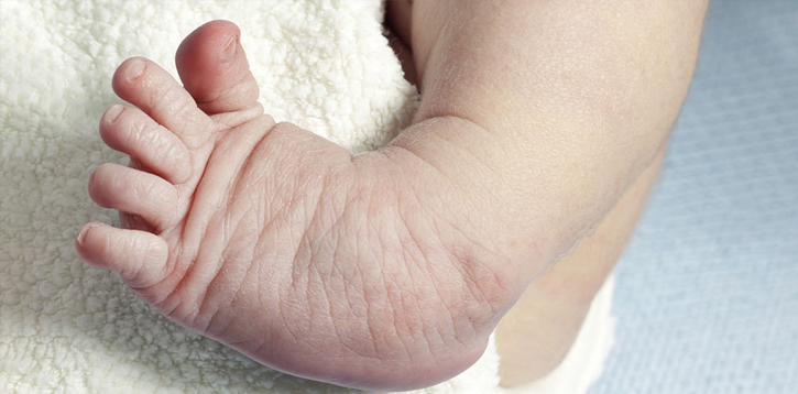 CLUB FOOT